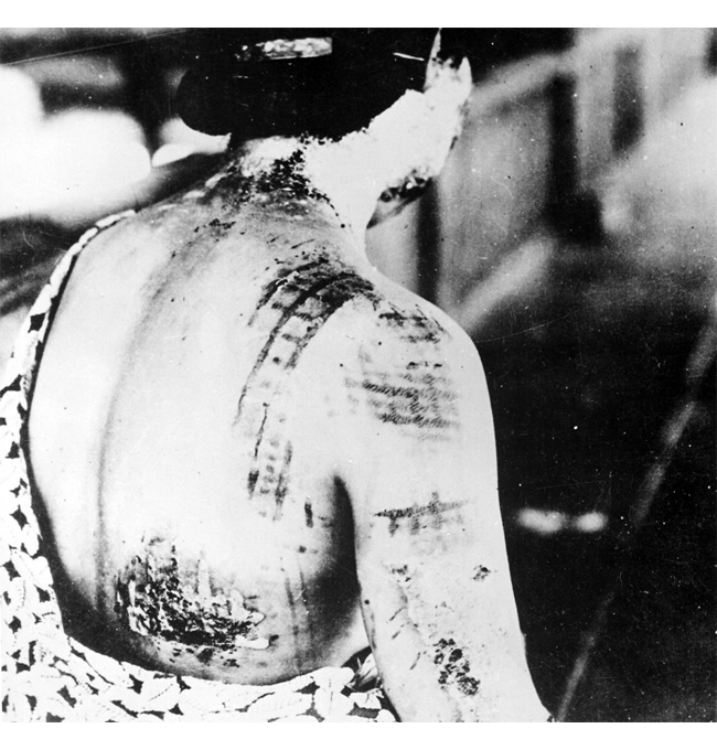Hiroshima - Aug 6, 1945: Flash Burn Marks